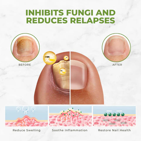 Fivfivgo™ FungiVanish Suero para tratamiento de uñas con veneno de abeja